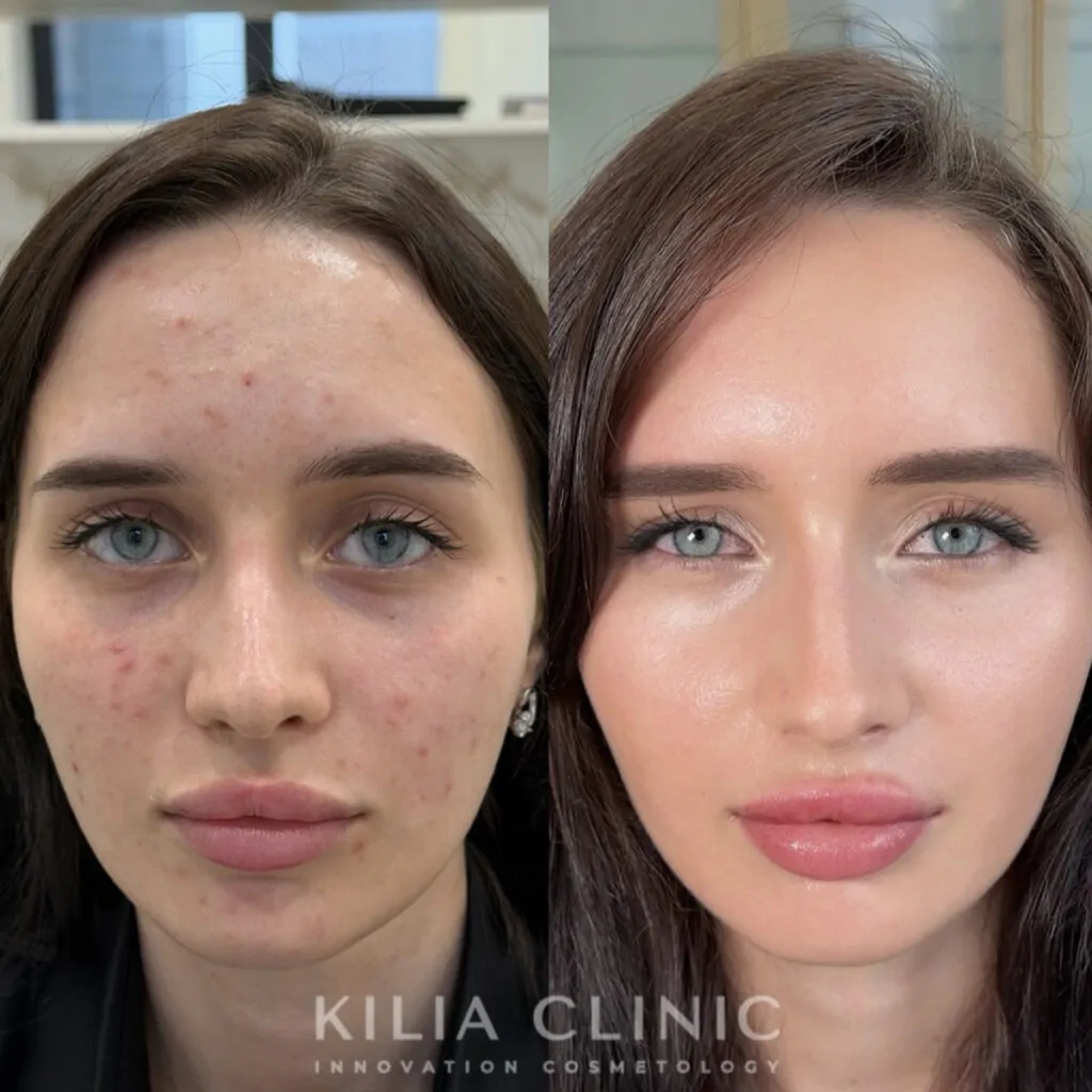Lumecca IPL + полинуклеотиды